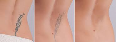 TATTOO REMOVAL LASER